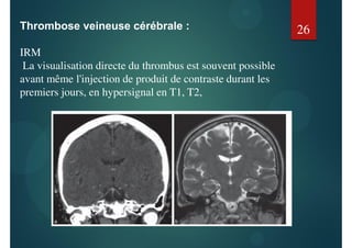 Thrombose veineuse cérébrale :
IRM
La visualisation directe du thrombus est souvent possible
avant même l'injection de produit de contraste durant les
premiers jours, en hypersignal en T1, T2,
26
 