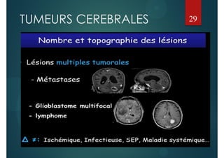 TUMEURS CEREBRALES 29
 