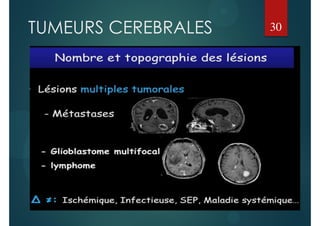 TUMEURS CEREBRALES 30
 