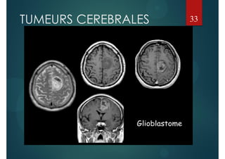 TUMEURS CEREBRALES 33
 