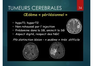 TUMEURS CEREBRALES 34
 