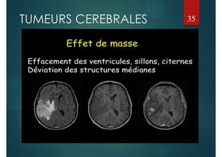 TUMEURS CEREBRALES 35
 