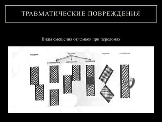 ТРАВМАТИЧЕСКИЕ ПОВРЕЖДЕНИЯ
Виды смещения отломков при переломах
 