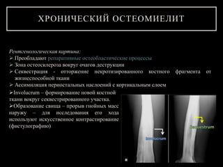 Рентгенологическая картина:
 Преобладают репаративные остеобластические процессы
 Зона остеосклероза вокруг очагов деструкции
 Секвестрация - отторжение некротизированного костного фрагмента от
жизнеспособной ткани
 Ассимиляция периостальных наслоений с кортикальным слоем
ХРОНИЧЕСКИЙ ОСТЕОМИЕЛИТ
Involucrum – формирование новой костной
ткани вокруг секвестрированного участка.
Образование свища – прорыв гнойных масс
наружу – для исследования его хода
используют искусственное контрастирование
(фистулографию)
 