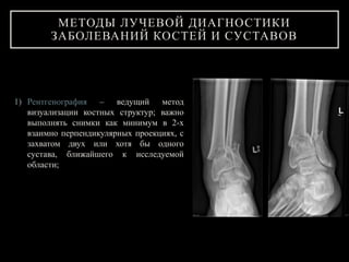 1) Рентгенография – ведущий метод
визуализации костных структур; важно
выполнять снимки как минимум в 2-х
взаимно перпендикулярных проекциях, с
захватом двух или хотя бы одного
сустава, ближайшего к исследуемой
области;
МЕТОДЫ ЛУЧЕВОЙ ДИАГНОСТИКИ
ЗАБОЛЕВАНИЙ КОСТЕЙ И СУСТАВОВ
 