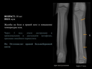 ВОЗРАСТ: 10 лет
ПОЛ: муж
Жалобы на боли в правой ноге и повышение
температуры тела.
Через 3 нед.: очаги деструкции в
проксимальном и дистальном метафизах,
признаки линейного периостита
Ds: Остеомиелит правой большеберцовой
кости
при поступлении через 3 нед.
 
