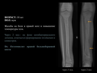 ВОЗРАСТ: 10 лет
ПОЛ: муж
Жалобы на боли в правой ноге и повышение
температуры тела.
Через 2 мес.: на фоне антибактериального
лечения, отмечается формирование involucrum и
секвестров.
Ds: Остеомиелит правой большеберцовой
кости
через 3 нед. через 2 мес.
 