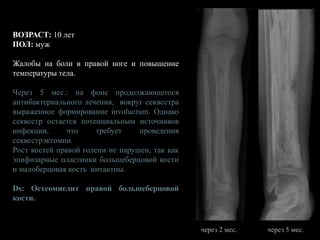 ВОЗРАСТ: 10 лет
ПОЛ: муж
Жалобы на боли в правой ноге и повышение
температуры тела.
Через 5 мес.: на фоне продолжающегося
антибактериального лечения, вокруг секвестра
выраженное формирование involucrum. Однако
секвестр остается потенциальным источников
инфекции, что требует проведения
секвестрэктомии.
Рост костей правой голени не нарушен, так как
эпифизарные пластинки большеберцовой кости
и малоберцовая кость интактны.
Ds: Остеомиелит правой большеберцовой
кости.
через 2 мес. через 5 мес.
 