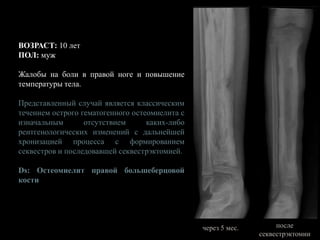 ВОЗРАСТ: 10 лет
ПОЛ: муж
Жалобы на боли в правой ноге и повышение
температуры тела.
Представленный случай является классическим
течением острого гематогенного остеомиелита с
изначальным отсутствием каких-либо
рентгенологических изменений с дальнейшей
хронизацией процесса с формированием
секвестров и последовавшей секвестрэктомией.
Ds: Остеомиелит правой большеберцовой
кости
через 5 мес. после
секвестрэктомии
 