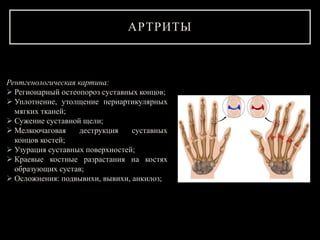 Рентгенологическая картина:
 Регионарный остеопороз суставных концов;
 Уплотнение, утолщение периартикулярных
мягких тканей;
 Сужение суставной щели;
 Мелкоочаговая деструкция суставных
концов костей;
 Узурация суставных поверхностей;
 Краевые костные разрастания на костях
образующих сустав;
 Осложнения: подвывихи, вывихи, анкилоз;
АРТРИТЫ
 