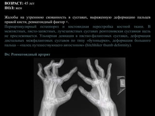 ВОЗРАСТ: 45 лет
ПОЛ: жен
Жалобы на утреннюю скованность в суставах, выраженную деформацию пальцев
правой кисти, ревматоидный фактор +.
Периартикулярный остеопороз и кистовидная перестройка костной ткани. В
межпястных, пясто-запястных, лучезапястных суставах рентгеновская суставная щель
не прослеживается. Ульнарная девиация в пястно-фаланговых суставах, деформация
дистальных межфаланговых суставов по типу «бутоньерки», деформация большого
пальца – «палец путешествующего автостопом» (hitchhiker thumb deformity).
Ds: Ревматоидный артрит
 