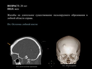 ВОЗРАСТ: 20 лет
ПОЛ: жен
Жалобы на длительное существование пальпируемого образования в
лобной области справа.
Ds: Остеома лобной кости
КТ, сагиттальная проекция КТ, 3D-рендеринг
 