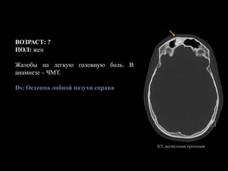 ВОЗРАСТ: ?
ПОЛ: жен
Жалобы на легкую головную боль. В
анамнезе – ЧМТ.
Ds: Остеома лобной пазухи справа
КТ, аксиальная проекция
 