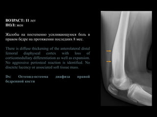 ВОЗРАСТ: 11 лет
ПОЛ: жен
Жалобы на постепенно усиливающуюся боль в
правом бедре на протяжении последних 8 мес.
There is diffuse thickening of the anterolateral distal
femoral diaphyseal cortex with loss of
corticomedullary differentiation as well as expansion.
No aggressive periosteal reaction is identified. No
discrete lucency or associated soft tissue mass.
Ds: Остеоид-остеома диафиза правой
бедренной кости
 
