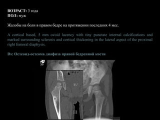 ВОЗРАСТ: 3 года
ПОЛ: муж
Жалобы на боли в правом бедре на протяжении последних 4 мес.
A cortical based, 5 mm ovoid lucency with tiny punctate internal calcifications and
marked surrounding sclerosis and cortical thickening in the lateral aspect of the proximal
right femoral diaphysis.
Ds: Остеоид-остеома диафиза правой бедренной кости
 