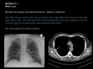 ВОЗРАСТ: ?
ПОЛ: муж
Жалобы на одышку. Из анамнеза жизни – работа с асбестом.
The chest X-ray reveals what was assumed to be a pleurally based mass in the right
upper chest wall. The subsequent CT confirmed that the mass was centered on the rib,
with non-aggressive appearances and expansion of the bone.
Ds: Энхондрома IV ребра справа
 