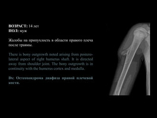 ВОЗРАСТ: 14 лет
ПОЛ: муж
Жалобы на припухлость в области правого плеча
после травмы.
There is bony outgrowth noted arising from postero-
lateral aspect of right humerus shaft. It is directed
away from shoulder joint. The bony outgrowth is in
continuity with the humerus cortex and medulla.
Ds: Остеохондрома диафиза правой плечевой
кости.
 