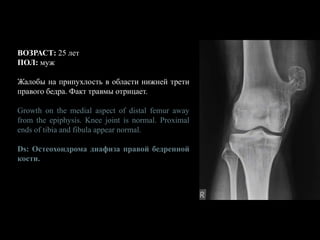 ВОЗРАСТ: 25 лет
ПОЛ: муж
Жалобы на припухлость в области нижней трети
правого бедра. Факт травмы отрицает.
Growth on the medial aspect of distal femur away
from the epiphysis. Knee joint is normal. Proximal
ends of tibia and fibula appear normal.
Ds: Остеохондрома диафиза правой бедренной
кости.
 