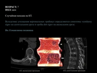 ВОЗРАСТ: ?
ПОЛ: жен
Случайная находка на КТ.
Вследствие утолщения вертикальных трабекул определяются симптомы «corduroy
sign» на сагиттальном срезе и «polka dot sign» на аксиальном срезе.
Ds: Гемангиома позвонка
КТ, сагиттальная проекция
КТ, аксиальная проекция
 