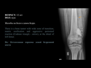 ВОЗРАСТ: 12 лет
ПОЛ: муж
Жалобы на боли в левом бедре.
There is a bone tumor with wide zone of transition,
matrix ossification and aggressive periosteal
reaction (Codman triangle - arrow), at the distal of
left femur.
Ds: Остеогенная саркома левой бедренной
кости
 