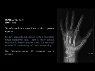 ВОЗРАСТ: 38 лет
ПОЛ: жен
Жалобы на боли в правой кисти. Факт травмы
отрицает.
Solitary, expansile, lytic lesion in the right middle
finger metacarpal head. There is minor cortical
breach in its inferior medial aspect. No periosteal
reaction. No surrounding soft tissue abnormality.
Ds: Хондросаркома III пястной кости
справа.
 
