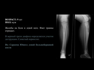 ВОЗРАСТ: 9 лет
ПОЛ: муж
Жалобы на боли в левой ноге. Факт травмы
отрицает.
В верхней трети диафиза определяется участок
деструкции. Слоистый периостит.
Ds: Саркома Юинга левой большеберцовой
кости
 