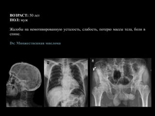 ВОЗРАСТ: 50 лет
ПОЛ: муж
Жалобы на немотивированную усталость, слабость, потерю массы тела, боли в
спине.
Ds: Множественная миелома
 