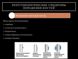 РЕНТГЕНОЛОГИЧЕСКИЕ СИНДРОМЫ
ПОРАЖЕНИЯ КОСТЕЙ
Виды периостальной реакции:
 линейная
 слоистая («луковичная»);
 бахромчатая;
 спикулообразная («игольчатая»);
 козырек Кодмана
Изменение контуров кости;
 
