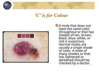 Mole Color Skin cancer and malignant melanoma management | PPT
