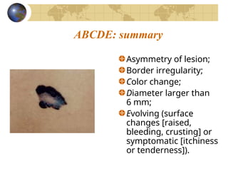 Skin cancer and malignant melanoma management | PPT