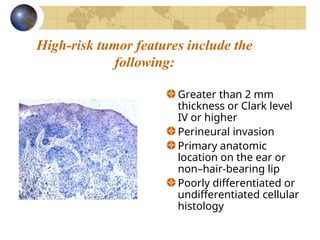 Skin cancer and malignant melanoma management | PPT