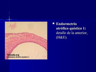  EndormetrioEndormetrio
atrófico quístico 1:atrófico quístico 1:  
detalle de la anterior, detalle de la anterior, 
(H&E).(H&E).  
 