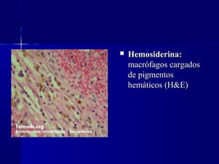  Hemosiderina:Hemosiderina:
macrófagos cargadosmacrófagos cargados
de pigmentosde pigmentos
hemáticos (H&E)hemáticos (H&E)
 