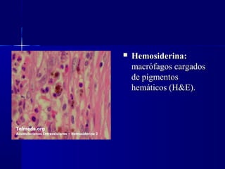  Hemosiderina:Hemosiderina:  
macrófagos cargadosmacrófagos cargados
de pigmentosde pigmentos
hemáticos (H&E).hemáticos (H&E).
 