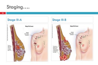 Staging….
26
Stage III-A Stage III-B
 