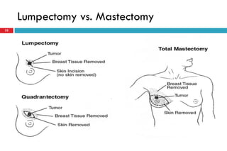 Lumpectomy vs. Mastectomy
33
 
