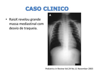 •RaioXrevelou grande massa mediastinalcom desvio de traqueia. 
Pediatrics in Review Vol.24 No.11 November 2003  