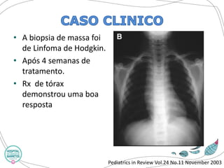 •A biopsia de massa foi de Linfoma de Hodgkin. 
•Após 4 semanas de tratamento. 
•Rxde tórax demonstrou uma boa resposta 
Pediatrics in Review Vol.24 No.11 November 2003  