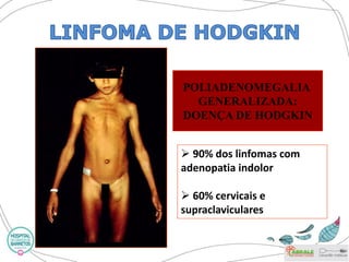 POLIADENOMEGALIA 
GENERALIZADA: 
DOENÇA DE HODGKIN 
 90% dos linfomas com 
adenopatia indolor 
 60% cervicais e 
supraclaviculares 
 