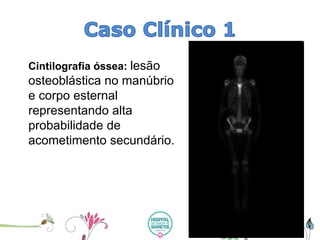 Cintilografiaóssea: lesão osteoblásticano manúbrio e corpo esternalrepresentando alta probabilidade de acometimento secundário.  