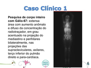 Pesquisa de corpo inteiro com Gálio-67: extensa área com aumento anômalo e difuso da concentração do radiotraçador, em grau acentuado na projeção do mediastino e perihilaresbilateralmente, nas projeções das supraclaviculares, axilares, terço inferior do pulmão direito e para-cardíaca.  