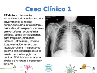 CT de tórax: formação expansivas todo mediastino com envolvimento de fossas supraclaviculares, retro peitorais, das axilas, dos espaços viscerais, pré vasculares, supra e infra aórticos, janela aortopulmonar, para traqueais, mamárias internas, infracarinal, recesso ázigo-esofágico, retro crural interaorticocaval. Infiltração de esterno com reação periostale erosão com interrupção da cortical. Nódulos pulmonares à direita de natureza à esclarecer (linfoma)  