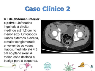 CT de abdômen inferior e pelve: Linfonodosinguinais à direita, medindo até 1,2 cm no menor eixo. Linfonodosilíacos externos à direita, o maior conglomerado envolvendo os vasos ilíacos, medindo até 4,3 cm no plano axial. A maior lesão desloca a bexiga para a esquerda.  