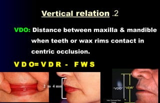 02- Definitions (Occlusion in prosthodontics) .pptx
