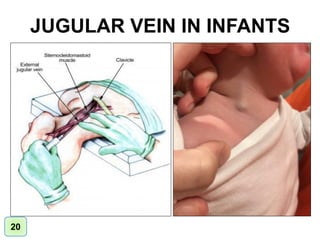 JUGULAR VEIN IN INFANTS
20
 