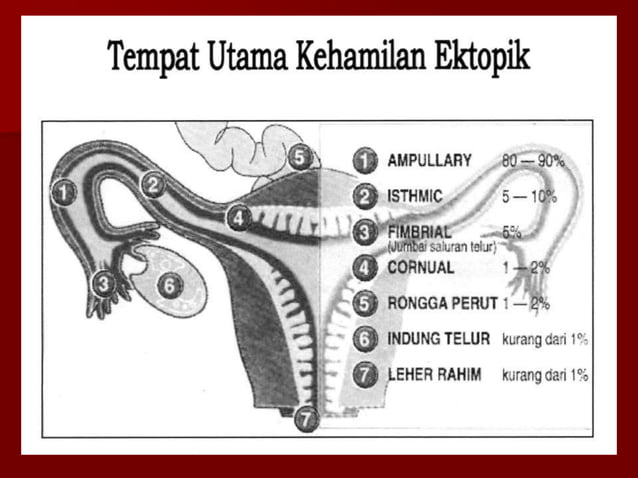 Ektopik 02-Kehamilan Ektopik - kehamilan di luar | PPT