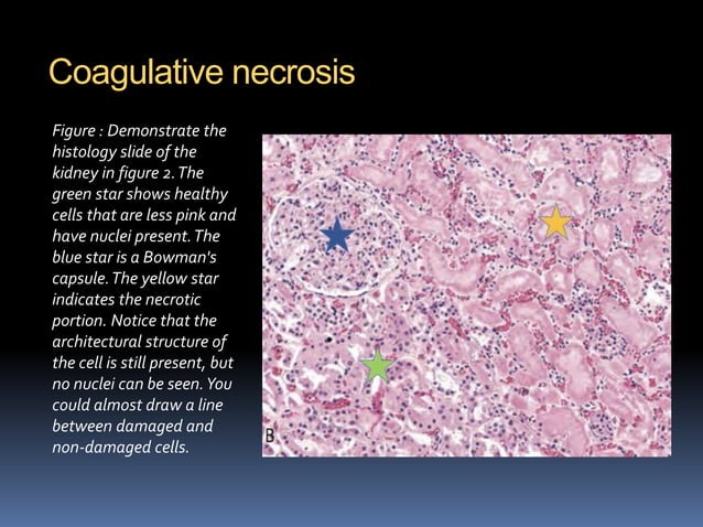 02-Necrosis and apoptosis-1.ppt
