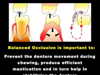 Balanced Occlusion is important to:
Prevent the denture movement during
chewing, produce efficient
mastication and in turn help in
 