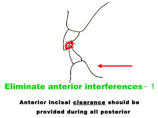 1-Eliminate anterior interferences
Anterior incisal clearance should be
provided during all posterior
 