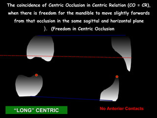 The coincidence of Centric Occlusion in Centric Relation (CO = CR),
when there is freedom for the mandible to move slightly forwards
from that occlusion in the same sagittal and horizontal plane
(Freedom in Centric Occlusion(.
““LONG” CENTRICLONG” CENTRIC No Anterior Contacts
 